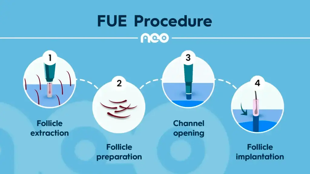 fue hair transplant